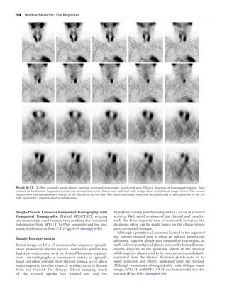 94  Nuclear Medicine: The Requisites
Single-Photon Emission Computed Tomography with
Computed Tomography.  Hybrid SPECT/CT systems
are increasingly used because they combine the functional
information from SPECT Tc-99m sestamibi and the ana-
tomical information from CT (Figs. 6-34 through 6-36).
Image Interpretation
Initial images at 10 to 15 minutes after injection typically
show prominent thyroid uptake, unless the patient has
had a thyroidectomy or is on thyroid hormone suppres-
sion. On scintigraphy a parathyroid uptake is typically
focal and often distinct from thyroid uptake, even when
superimposed; in other cases, it is adjacent to or distant
from the thyroid. On delayed 2-hour imaging, much
of the thyroid uptake has washed out and the
hyperfunctioning parathyroid gland is a focus of residual
activity. With rapid washout of the thyroid and parathy-
roid, the false negative rate is increased; however, the
diagnosis often can be made based on the characteristic
pattern on early images.
Although a parathyroid adenoma located in the region of
the inferior thyroid lobe is often an inferior parathyroid
adenoma, superior glands may descend to that region, as
well. Inferior parathyroid glands are usually located imme-
diately adjacent to the posterior aspect of the thyroid,
while superior glands tend to be more posterior and clearly
separated from the thyroid. Superior glands tend to be
more posterior and clearly separated from the thyroid.
Although sometimes distinguishable with oblique static
image, SPECT and SPECT/CT can better make this dis-
tinction (Figs. 6-34 through 6-36).
Figure 6-33.  Tc-99m sestamibi single-photon emission computed tomography parathyroid scan. Clinical diagnosis of hyperparathyroidism. Scan
ordered for localization. Sequential coronal (top two) and transverse (bottom two), each with early images above and delayed images below. The coronal
images show that the adenoma is inferior to the thyroid on the left side. The transverse images show that the parathyroid is rather posterior on the left
side, suggesting a superior parathyroid adenoma.
 