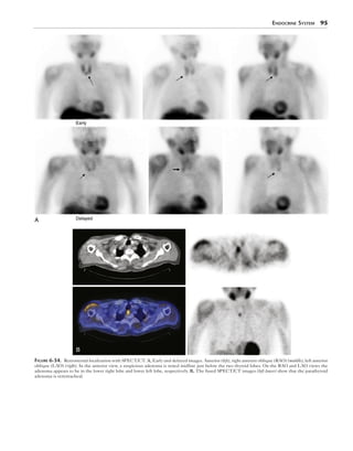 Endocrine System  95
A
Early
Delayed
B
Figure 6-34.  Retrosternal localization with SPECT/CT. A, Early and delayed images. Anterior (left), right anterior oblique (RAO) (middle), left anterior
oblique (LAO) (right). In the anterior view, a suspicious adenoma is noted midline just below the two thyroid lobes. On the RAO and LAO views the
adenoma appears to be in the lower right lobe and lower left lobe, respectively. B, The fused SPECT/CT images (left lower) show that the parathyroid
adenoma is retrotracheal.
 