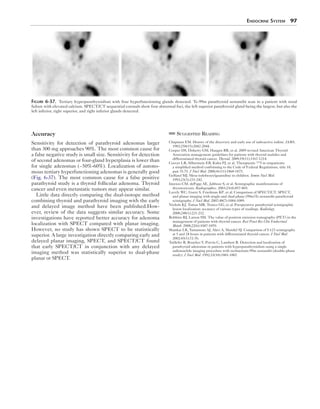 Endocrine System  97
Figure 6-37.  Tertiary hyperparathyroidism with four hyperfunctioning glands detected. Tc-99m parathyroid sestamibi scan in a patient with renal
failure with elevated calcium. SPECT/CT sequential coronals show four abnormal foci, the left superior parathyroid gland being the largest, but also the
left inferior, right superior, and right inferior glands detected.
Accuracy
Sensitivity for detection of parathyroid adenomas larger
than 300 mg approaches 90%. The most common cause for
a false negative study is small size. Sensitivity for detection
of second adenomas or four-gland hyperplasia is lower than
for single adenomas (~50%-60%). Localization of autono-
mous tertiary hyperfunctioning adenomas is generally good
(Fig. 6-37). The most common cause for a false positive
parathyroid study is a thyroid follicular adenoma. Thyroid
cancer and even metastatic tumors may appear similar.
Little data directly comparing the dual-isotope method
combining thyroid and parathyroid imaging with the early
and delayed image method have been published.How-
ever, review of the data suggests similar accuracy. Some
investigations have reported better accuracy for adenoma
localization with SPECT compared with planar imaging.
However, no study has shown SPECT to be statistically
superior. A large investigation directly comparing early and
delayed planar imaging, SPECT, and SPECT/CT found
that early SPECT/CT in conjunction with any delayed
imaging method was statistically superior to dual-phase
planar or SPECT.
Suggested Reading
Chapman EM. History of the discovery and early use of radioactive iodine. JAMA.
1983;250(15):2042-2044.
Cooper DS, Doherty GM, Haugen BR, et al. 2009 revised American Thyroid
Association management guidelines for patients with thyroid nodules and
differentiated thyroid cancer. Thyroid. 2009;19(11):1167-1214.
Coover LR, Silberstein EB, Kuhn PJ, et al. Therapeutic 131I in outpatients:
a simplified method conforming to the Code of Federal Regulations, title 10,
part 35.75. J Nucl Med. 2000;41(11):1868-1875.
Gelfand MJ. Meta-iodobenzylguanidine in children. Semin Nucl Med.
1993;23(3):231-242.
Intenzo CM, dePapp AE, Jabbour S, et al. Scintigraphic manifestations of
thyrotoxicosis. Radiographics. 2003;23(4):857-869.
Lavely WC, Goetz S, Friedman KP, et al. Comparison of SPECT/CT, SPECT,
and planar imaging with single-and dual-phase (99m)Tc-sestamibi parathyroid
scintigraphy. J Nucl Med. 2007;48(7):1084-1089.
Nichols KJ, Tomas MB, Tronco GG, et al. Preoperative parathyroid scintigraphic
lesion localization: accuracy of various types of readings. Radiology.
2008;248(1):221-232.
Robbins RJ, Larson SM. The value of positron emission tomography (PET) in the
management of patients with thyroid cancer. Best Pract Res Clin Endocrinol
Metab. 2008;22(6):1047-1059.
Shankar LK, Yamamoto AJ, Alavi A, Mandel SJ. Comparison of I-123 scintigraphy
at 5 and 24 hours in patients with differentiated thyroid cancer. J Nucl Med.
2002;43(1):72-76.
Taillefer R, Boucher Y, Potvin C, Lambert R. Detection and localization of
parathyroid adenomas in patients with hyperparathyroidism using a single
radionuclide imaging procedure with technetium-99m sestamibi (double-phase
study). J Nucl Med. 1992;33(10):1801-1807.
 