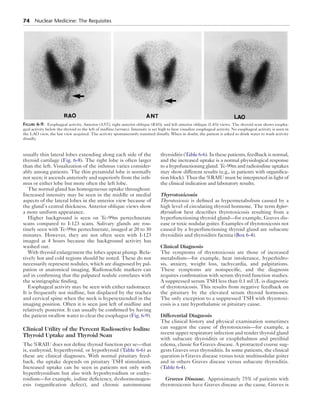 74  Nuclear Medicine: The Requisites
usually thin lateral lobes extending along each side of the
thyroid cartilage (Fig. 6-8). The right lobe is often larger
than the left. Visualization of the isthmus varies consider-
ably among patients. The thin pyramidal lobe is normally
not seen; it ascends anteriorly and superiorly from the isth-
mus or either lobe but more often the left lobe.
The normal gland has homogeneous uptake throughout.
Increased intensity may be seen in the middle or medial
aspects of the lateral lobes in the anterior view because of
the gland’s central thickness. Anterior oblique views show
a more uniform appearance.
Higher background is seen on Tc-99m pertechnetate
scans compared to I-123 scans. Salivary glands are rou-
tinely seen with Tc-99m pertechnetate, imaged at 20 to 30
minutes. However, they are not often seen with I-123
imaged at 4 hours because the background activity has
washed out.
With thyroid enlargement the lobes appear plump. Rela-
tively hot and cold regions should be noted. These do not
necessarily represent nodules, which are diagnosed by pal-
pation or anatomical imaging. Radionuclide markers can
aid in confirming that the palpated nodule correlates with
the scintigraphic finding.
Esophageal activity may be seen with either radiotracer.
It is frequently not midline, but displaced by the trachea
and cervical spine when the neck is hyperextended in the
imaging position. Often it is seen just left of midline and
relatively posterior. It can usually be confirmed by having
the patient swallow water to clear the esophagus (Fig. 6-9).
Clinical Utility of the Percent Radioactive Iodine
Thyroid Uptake and Thyroid Scan
The %RAIU does not define thyroid function per se—that
is, euthyroid, hyperthyroid, or hypothyroid (Table 6-6) as
these are clinical diagnoses. With normal pituitary feed-
back, the uptake depends on pituitary TSH stimulation.
Increased uptake can be seen in patients not only with
hyperthyroidism but also with hypothyroidism or euthy-
roidism—for example, iodine deficiency, dyshormonogen-
esis (organification defect), and chronic autoimmune
thyroiditis (Table 6-6). In these patients, feedback is normal,
and the increased uptake is a normal physiological response
to a hypofunctioning gland. Tc-99m and radioiodine uptakes
may show different results (e.g., in patients with organifica-
tion block). Thus the %RAIU must be interpreted in light of
the clinical indication and laboratory results.
Thyrotoxicosis
Thyrotoxicosis is defined as hypermetabolism caused by a
high level of circulating thyroid hormone. The term hyper-
thyroidism best describes thyrotoxicosis resulting from a
hyperfunctioning thyroid gland—for example, Graves dis-
ease or toxic nodular goiter. Examples of thyrotoxicosis not
caused by a hyperfunctioning thyroid gland are subacute
thyroiditis and thyroiditis factitia (Box 6-4).
Clinical Diagnosis
The symptoms of thyrotoxicosis are those of increased
metabolism—for example, heat intolerance, hyperhidro-
sis, anxiety, weight loss, tachycardia, and palpitations.
These symptoms are nonspecific, and the diagnosis
requires confirmation with serum thyroid function studies.
A suppressed serum TSH less than 0.1 mU/L is diagnostic
of thyrotoxicosis. This results from negative feedback on
the pituitary by the elevated serum thyroid hormones.
The only exception to a suppressed TSH with thyrotoxi-
cosis is a rare hypothalamic or pituitary cause.
Differential Diagnosis
The clinical history and physical examination sometimes
can suggest the cause of thyrotoxicosis—for example, a
recent upper respiratory infection and tender thyroid gland
with subacute thyroiditis or exophthalmos and pretibial
edema, classic for Graves disease. A protracted course sug-
gests Graves over thyroiditis. In some patients, the clinical
question is Graves disease versus toxic multinodular goiter
and in others Graves disease versus subacute thyroiditis.
(Table 6-4).
Graves Disease.  Approximately 75% of patients with
thyrotoxicosis have Graves disease as the cause. Graves is
Figure 6-9.  Esophageal activity. Anterior (ANT), right anterior oblique (RAO), and left anterior oblique (LAO) views. The thyroid scan shows esopha-
geal activity below the thyroid to the left of midline (arrows). Intensity is set high to best visualize esophageal activity. No esophageal activity is seen in
the LAO view, the last view acquired. The activity spontaneously transited distally. When in doubt, the patient is asked to drink water to wash activity
distally.
 