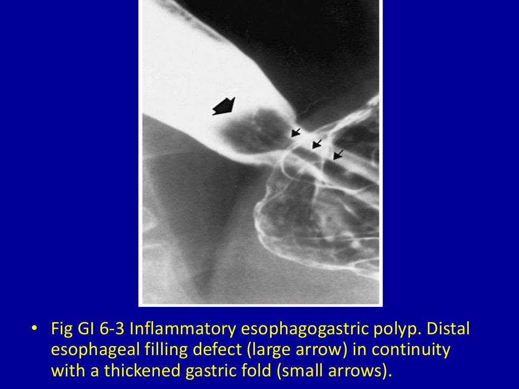 6 esophageal filling defects