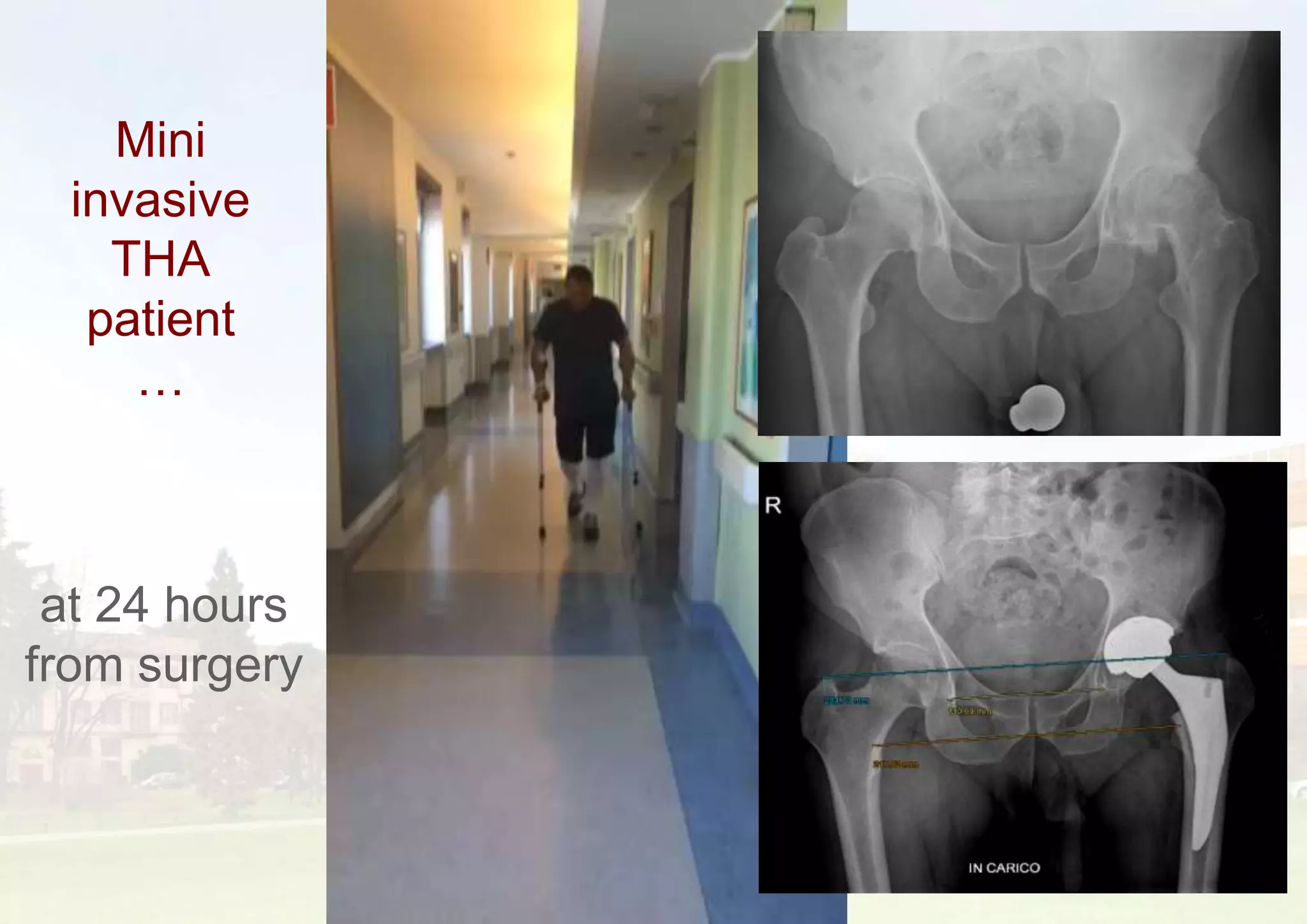 Mini
invasive
THA
patient
…
29
at 24 hours
from surgery
 