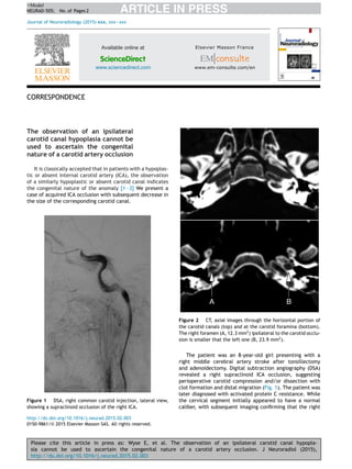 Please cite this article in press as: Wyse E, et al. The observation of an ipsilateral carotid canal hypopla-
sia cannot be used to ascertain the congenital nature of a carotid artery occlusion. J Neuroradiol (2015),
http://dx.doi.org/10.1016/j.neurad.2015.02.003
ARTICLE IN PRESS+Model
NEURAD-505; No. of Pages 2
Journal of Neuroradiology (2015) xxx, xxx—xxx
Available online at
ScienceDirect
www.sciencedirect.com
CORRESPONDENCE
The observation of an ipsilateral
carotid canal hypoplasia cannot be
used to ascertain the congenital
nature of a carotid artery occlusion
It is classically accepted that in patients with a hypoplas-
tic or absent internal carotid artery (ICA), the observation
of a similarly hypoplastic or absent carotid canal indicates
the congenital nature of the anomaly [1—3] We present a
case of acquired ICA occlusion with subsequent decrease in
the size of the corresponding carotid canal.
Figure 1 DSA, right common carotid injection, lateral view,
showing a supraclinoid occlusion of the right ICA.
Figure 2 CT, axial images through the horizontal portion of
the carotid canals (top) and at the carotid foramina (bottom).
The right foramen (A, 12.3 mm2
) ipsilateral to the carotid occlu-
sion is smaller that the left one (B, 23.9 mm2
).
The patient was an 8-year-old girl presenting with a
right middle cerebral artery stroke after tonsillectomy
and adenoidectomy. Digital subtraction angiography (DSA)
revealed a right supraclinoid ICA occlusion, suggesting
perioperative carotid compression and/or dissection with
clot formation and distal migration (Fig. 1). The patient was
later diagnosed with activated protein C resistance. While
the cervical segment initially appeared to have a normal
caliber, with subsequent imaging conﬁrming that the right
http://dx.doi.org/10.1016/j.neurad.2015.02.003
0150-9861/© 2015 Elsevier Masson SAS. All rights reserved.
 