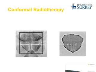 Conformal Radiotherapy 