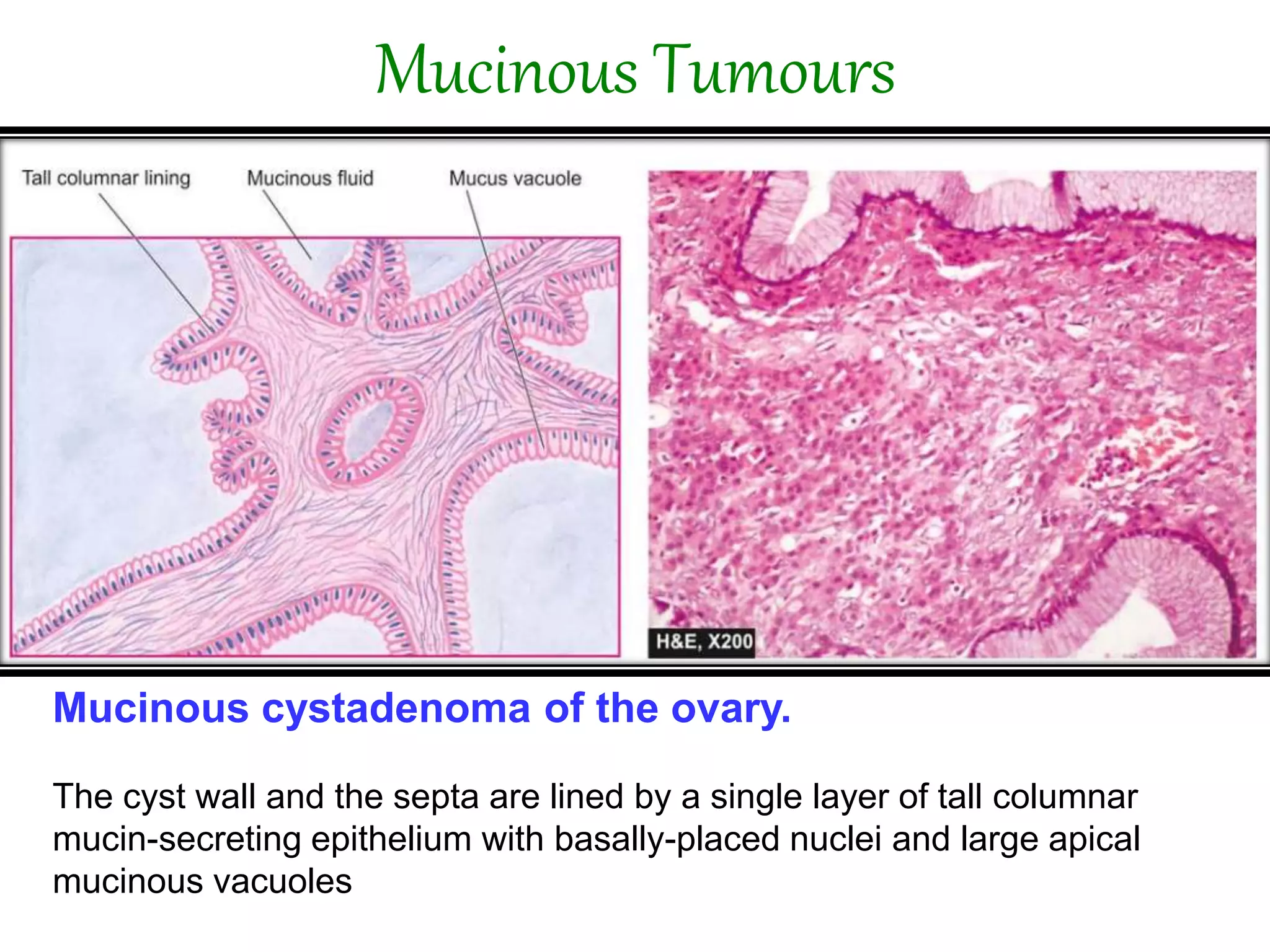 FEMALE GENITAL TRACT OVARIAN TUMOURS PPTX female-genital-tract-ovarian-tumours-pptx