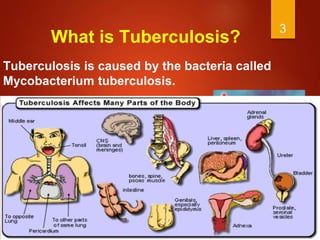 3
What is Tuberculosis?
Tuberculosis is caused by the bacteria called
Mycobacterium tuberculosis.
 