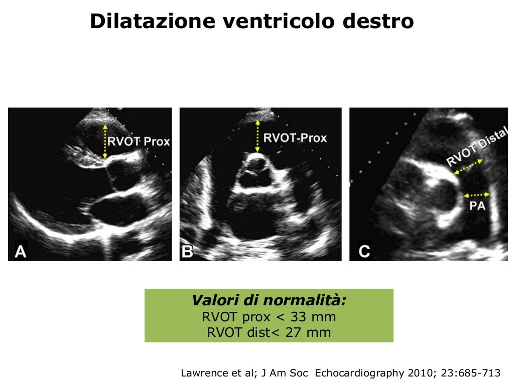 La valutazione ecocardiografica della funzione ventricolare destra