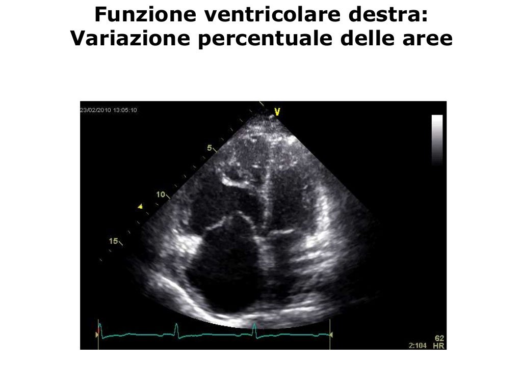 La valutazione ecocardiografica della funzione ventricolare destra