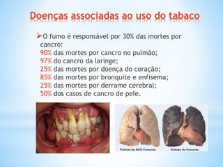Doenças associadas ao uso do tabaco
O fumo é responsável por 30% das mortes por
cancro:
90% das mortes por cancro no pulmão;
97% do cancro da laringe;
25% das mortes por doença do coração;
85% das mortes por bronquite e enfisema;
25% das mortes por derrame cerebral;
50% dos casos de cancro de pele.
 