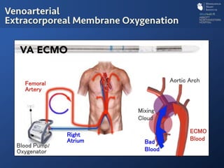 Venoarterial
Extracorporeal Membrane Oxygenation
!
!
/ !
!
!
!
!
/!
!
VA ECMO
!
!
!
!
!
!
!
 