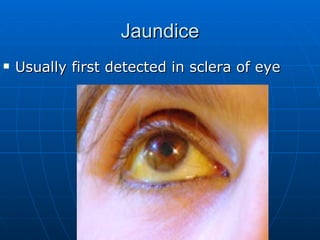 Jaundice Usually first detected in sclera of eye 