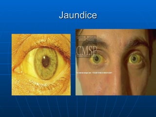 Jaundice 