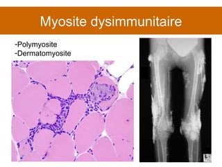 Myosite dysimmunitaire Polymyosite Dermatomyosite 