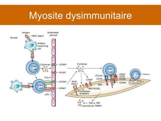 Myosite dysimmunitaire 