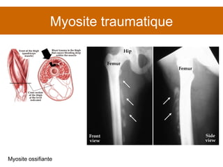 Myosite traumatique Myosite ossifiante 