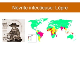 Névrite infectieuse: Lèpre 