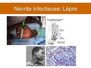 Névrite infectieuse: Lèpre 