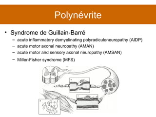 Polynévrite Syndrome de Guillain-Barré acute inflammatory demyelinating polyradiculoneuropathy (AIDP) acute motor axonal neuropathy (AMAN) acute motor and sensory axonal neuropathy (AMSAN) Miller-Fisher syndrome (MFS)   
