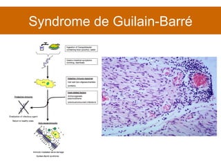 Syndrome de Guilain-Barré 