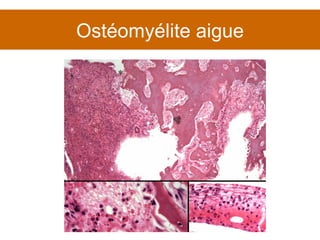 Ostéomyélite aigue 