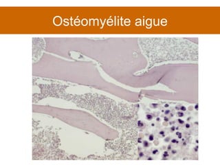 Ostéomyélite aigue 