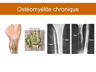 Ostéomyélite chronique 