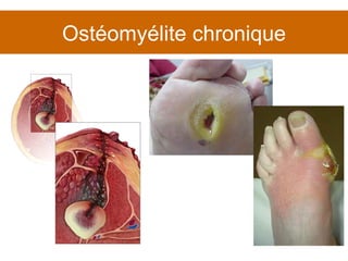 Ostéomyélite chronique 