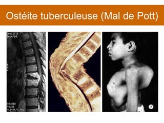 Ostéite tuberculeuse (Mal de Pott) 