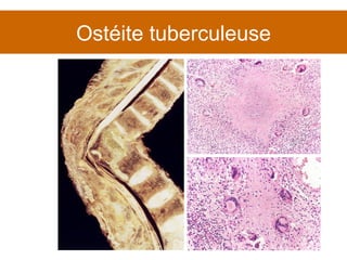 Ostéite tuberculeuse 