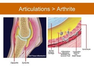Articulations > Arthrite 