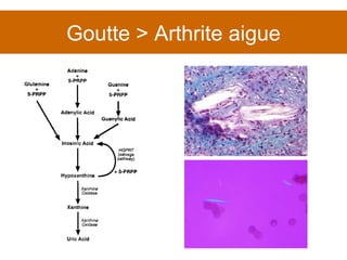 Goutte > Arthrite aigue 