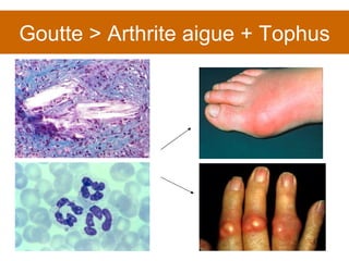 Goutte > Arthrite aigue + Tophus 