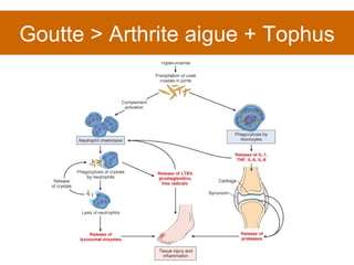Goutte > Arthrite aigue + Tophus 