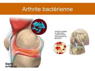 Arthrite bactérienne 