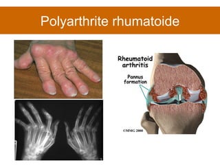 Polyarthrite rhumatoide 