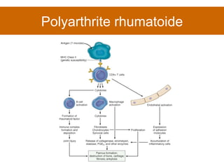 Polyarthrite rhumatoide 