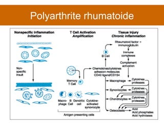 Polyarthrite rhumatoide 
