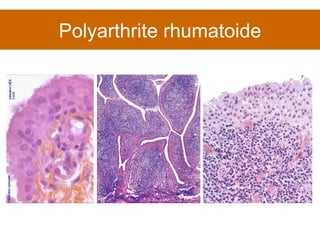 Polyarthrite rhumatoide 