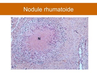 Nodule rhumatoide 