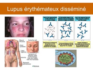 Lupus érythémateux disséminé 