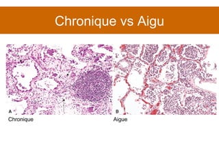Chronique vs Aigu Chronique Aigue 