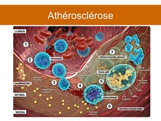 Athérosclérose 