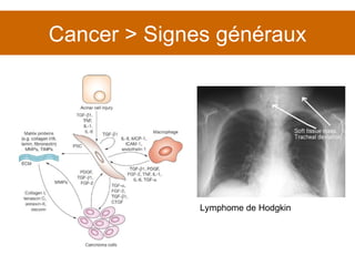 Cancer > Signes généraux Lymphome de Hodgkin 