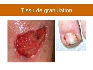 Tissu de granulation 