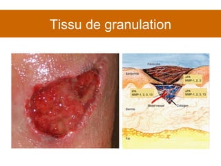 Tissu de granulation 