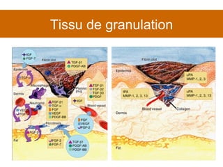 Tissu de granulation 