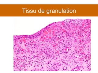 Tissu de granulation 