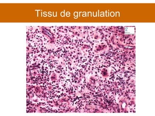 Tissu de granulation 