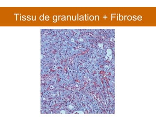 Tissu de granulation + Fibrose 