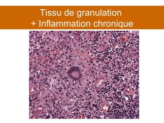 Tissu de granulation  + Inflammation chronique 